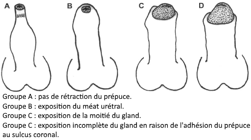 plastie du prépuce ou circoncision