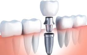 implant dentaire Turquie 