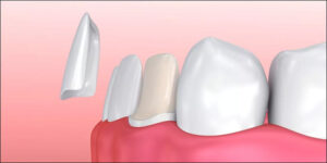 facette veneer hongrie