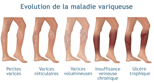 traitement varice sclérothérapie