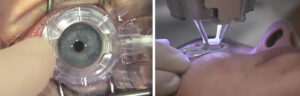 lasik turquie