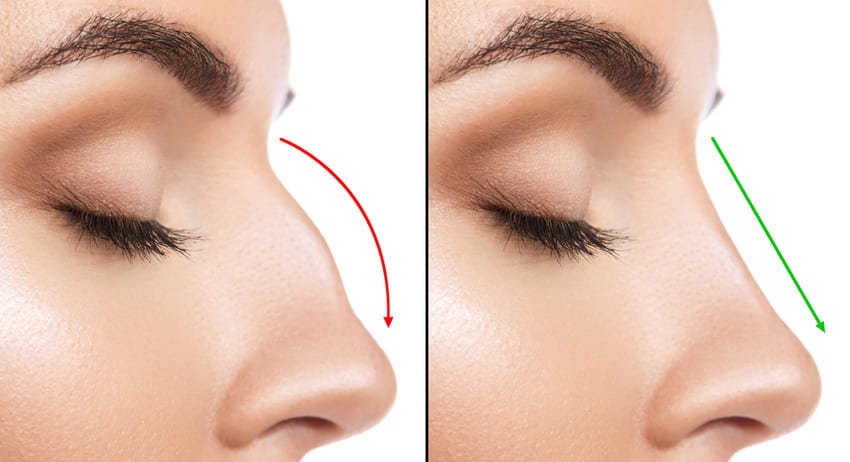 Conseils rhinoplastie à l'étranger