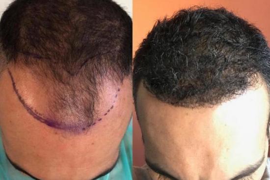 Prix Greffe Cheveux Synthétique Biofibre Turquie