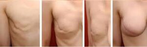 Lipofilling en reconstruction mammaire