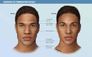 Chirurgie de féminisation faciale pour transgenres