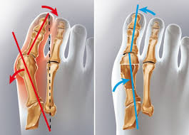 Évolution de la chirurgie de l’hallux valgus en Turquie