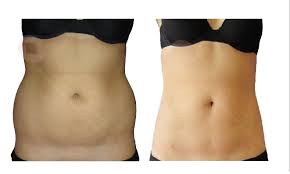 Liposuccion skinboosters