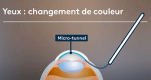 Kératopigmentation Turquie – Changer la couleur des yeux 