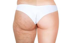 techniques efficaces et traitements cellulite Turquie