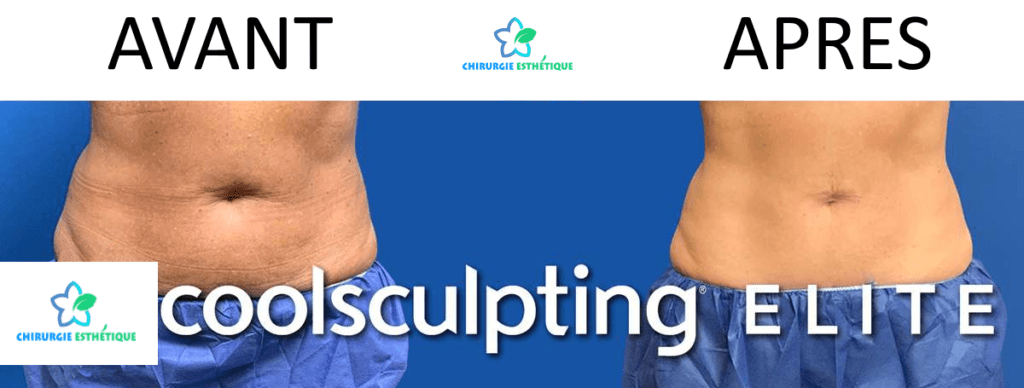 COOLSCULPTING ELITE TURQUIE