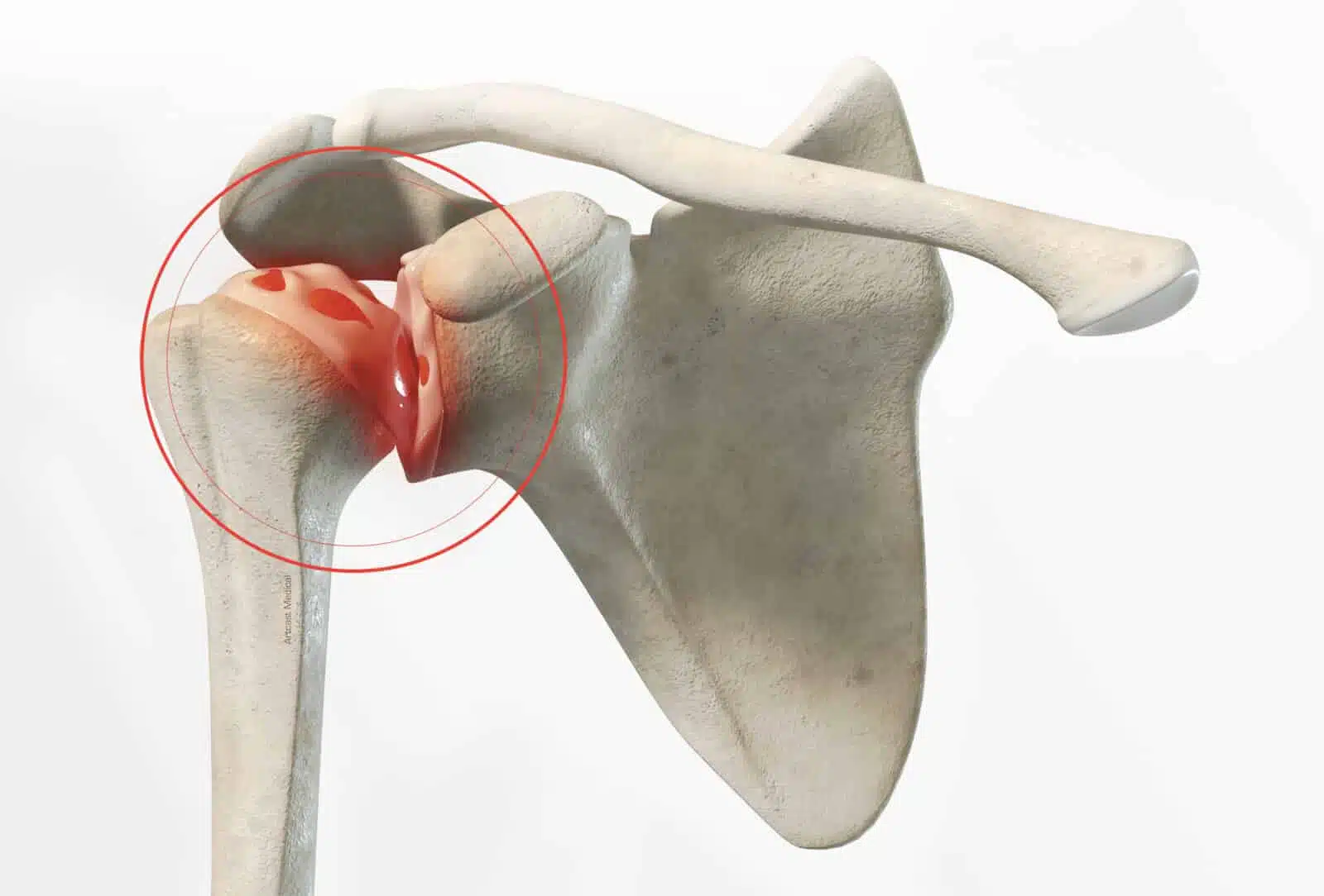 arthrose de l'épaule