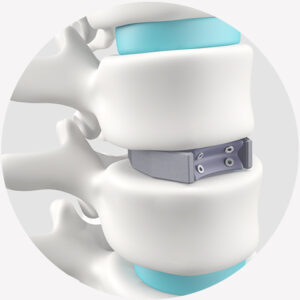 fusion colonne vertebrale