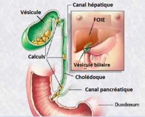 cholécystectomie en Turquie