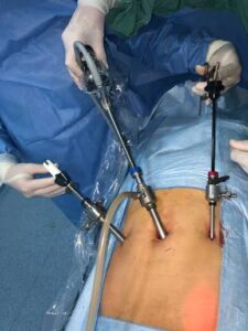 Chirurgie ouverte ou cœlioscopie