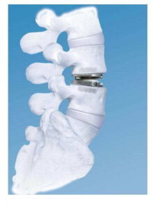 Remplacement discal