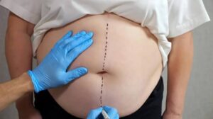 chirurgie bariatrique revisionnelle