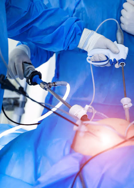 Chirurgie ouverte ou cœlioscopie