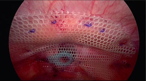 récupération après une chirurgie de hernie