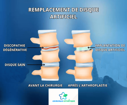 Remplacement discal
