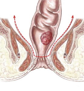 Chirurgie colorectale 