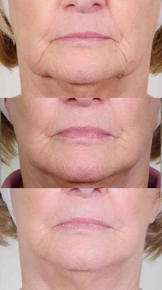 Retendre la peau sans lifting : FAQ sur les traitements